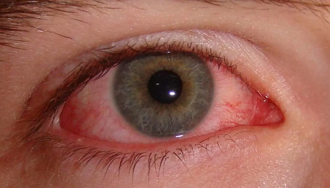 viral_eye_conjunnctivitis